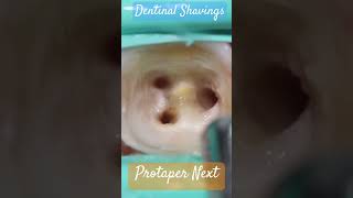 Dentinal Shavings 🔵 Protaper Next ⚪️ atozkidsdental toothisland [upl. by Duma]