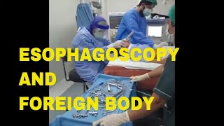 Covid and Esophagoscopy  Endoscopy and Foreign Body removal  Dr Sultan Badar Munir  Endoscopy [upl. by Innep]