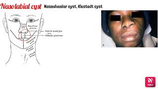 NON ODONTOGENIC CYSTS [upl. by Tezile]