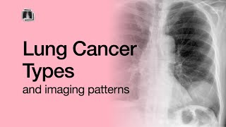 Lung Cancer Types [upl. by Acinoda243]