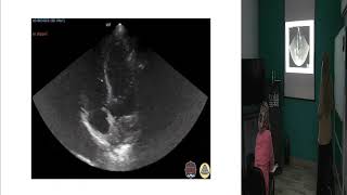 Infective Endocarditis Dr Hanady El Feky [upl. by Mckenzie]