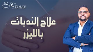 استخدام الليزر في علاج الندبات و الجروح [upl. by Carlene]