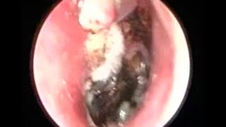 Severe Fungal Ear Infection cleaning by suction irrigation [upl. by Aurita]