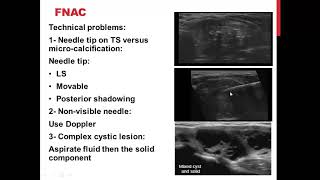 Thyroid Imaging Thyroid Nodules 3 [upl. by O'Conner]