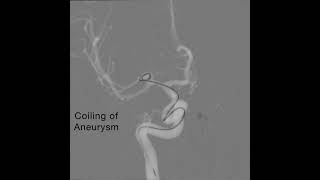 Single Microcatheter Coiling [upl. by Enneirda]