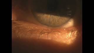 trichiasis misdirected eyelash [upl. by Morey]