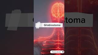 Glioblastoma or GBM  the aggressive brain tumor glioblastoma gbm brain tumores cancer [upl. by Eirena295]