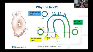 Dr Eric Roselli on Aortic Root Surgery in Connective Tissue Conditions [upl. by Enovi505]