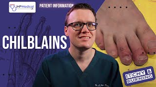 How To Get Rid Of CHILBLAINS Pernio Itchy Sores On Your Fingers And Toes  Doctor Explains [upl. by Stefanac]