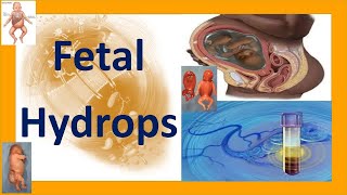 Fetal Hydrops  Hydrops Fetalis  Fetal Hydrops Causes Complications Treatment and Prognosis [upl. by Mulloy]