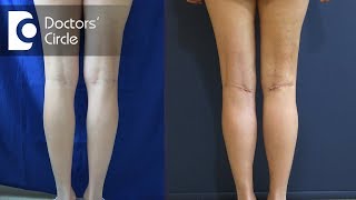 Surgical correction of bow legs  Dr Surindher D S A [upl. by Acacia257]