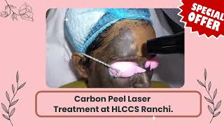 Carbon peel laser treatment at hlccs ranchi Call now 9334334935 carbonfacial skincare [upl. by Lelah583]