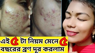 আমি কিভাবে ৫ বছরের ব্রণ থেকে মুক্তি পেলাম 5 tips pimple treatment at home [upl. by Anirtruc285]