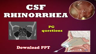 CSF RHINORRHEA  ENT  Easy explanation  All you need to know [upl. by Enoch543]