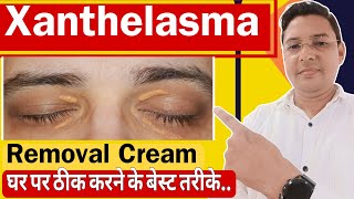 Xanthelasma Removal Cream  How to treat Xanthelasma home Remedies [upl. by Tung]