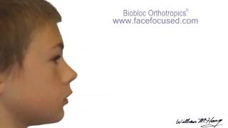 Dr Hangs Biobloc Orthotropic ® Treatment  Morph [upl. by Schreiber922]