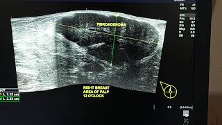 fibroadenoma breast ultrasound [upl. by Kcirdef]