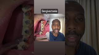 Gengivectomia dentes gengiva dentista [upl. by Cary]