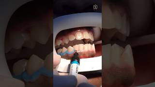 Dentistapproved teeth whitening treatment shorts whiteteeth dentistry dentist [upl. by Changaris39]