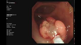 大腸息肉黏膜切除術 Snare Endoscopic Mucosal Resection EMR of cecal adenoma [upl. by Ellissa204]