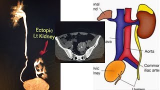 Ectopic Kidney full CT image [upl. by Sethrida66]