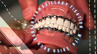 Intermaxillary Fixation with Erich Arch Bars [upl. by Finnigan]