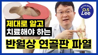 ⁉이 증상이 있다면 정형외과에 방문하시기 바랍니다2편 I 반월상 연골판 파열 [upl. by Ardien]