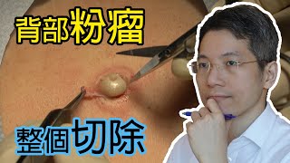 背部粉瘤  粉瘤取出  微創  表皮樣囊腫  Dermatologist  Back epidermoid cyst  角蛋白  皮膚活檢手術  皮膚專科 [upl. by Sirapal]