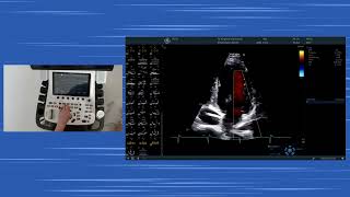 〖Echocardiography〗 Apical views handson  Color MMode diastolic dysfunction amp the RV TAPSE S [upl. by Norby583]