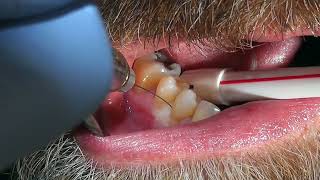 Easy Tooth Extraction  Dental Minute with Steven T Cutbirth DDS [upl. by Ihdin]