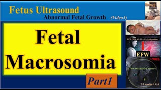 Fetus Ultrasound Fetal Macrosomia Part1 [upl. by Aicelav166]