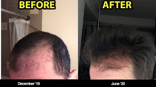 1 REASON WHY YOU SHOULD BE MICRONEEDLING FOR HAIR LOSS BEFOREAFTER PHOTOS [upl. by Nissensohn647]