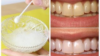 Como clarear os dentes em 1 minuto por menos de 10 reais [upl. by Ordnajela]