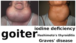 goiter [upl. by Yanal]