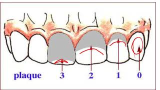 PLAQUE INDEXFABDENTIST [upl. by Oak]