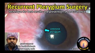 CataractCoach 1038 recurrent pterygium surgery [upl. by Kehsihba514]