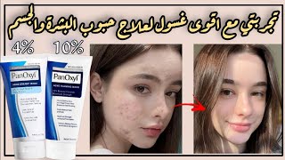 افضل غسول لعلاج الحبوب  العلاج السحري للحبوب  غسول بانوكسل لحبوب البشرة والجسم Panoxyl acne wash [upl. by Sirromal]