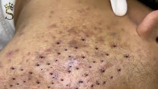 Big Cystic Acne Blackheads Extraction Blackheads amp Milia Whiteheads Removal Pimple Popping  3906 [upl. by Einafpets]