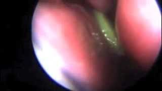 Foriegn Bodies Nose Endoscopic removal [upl. by Mat394]