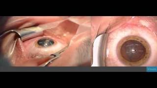 Refractive lens exchange with multifocal lens implantation [upl. by Memberg]