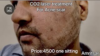 I got franctional CO2 Laser Treatment for Acne Scars  first sitting  Before After Results [upl. by Ynneh]