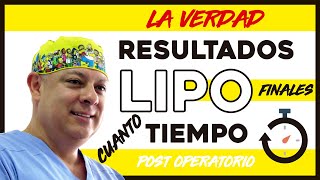 La VERDAD sobre la recuperación de una LIPOSUCCION y los RESULTADOS Lipo lipolaser lipoescultura [upl. by Llerahs]