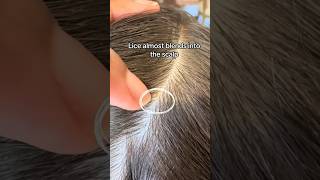 Lice blends into scalp l lice services l small business explore hair shorts lice [upl. by Einnad775]