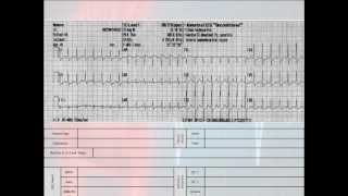 12 Lead Interpretation Part 62 EKG Changes and Lead Localization of Myocardial Infarctions [upl. by Gibe]