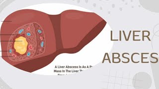 TOPICquot30LIVER ABSCESSamp ITS CAUSES SIGN SYMPTOMS DIAGNOSIS AND TREATMENT [upl. by Reace]