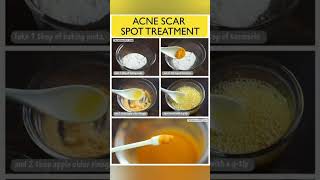 Home Remedies For Acne And Pimples ❤️❣️skincare acnetreatment shortvideo [upl. by Dnumsed]