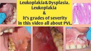 Leukoplakia and DysplasiaLeukoplakia amp its grades of severitythis video all type Leukoplakiaamp PVL [upl. by Otrebogir]