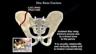 Iliac Bone Fracture  Everything You Need To Know  Dr Nabil Ebraheim [upl. by Delcine]