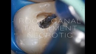 ROOT CANAL TREATMENT 16 necrotic case [upl. by Aihsile]