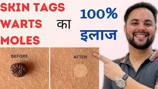 Skin Tags Warts amp Moles का 100 इलाज with Home Remedies [upl. by Werd806]